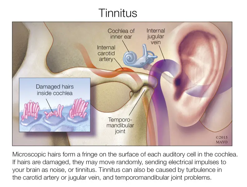 Short Description Tinnitus