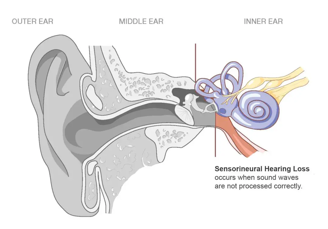 Sensorineural hearing loss and It?s Causes Pulsatile Tinnitus
