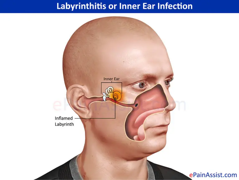 Ear infection and Treatment - Pulsatile Tinnitus