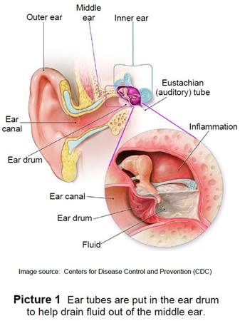Tinnitus and Fluid Behind the Eardrum
